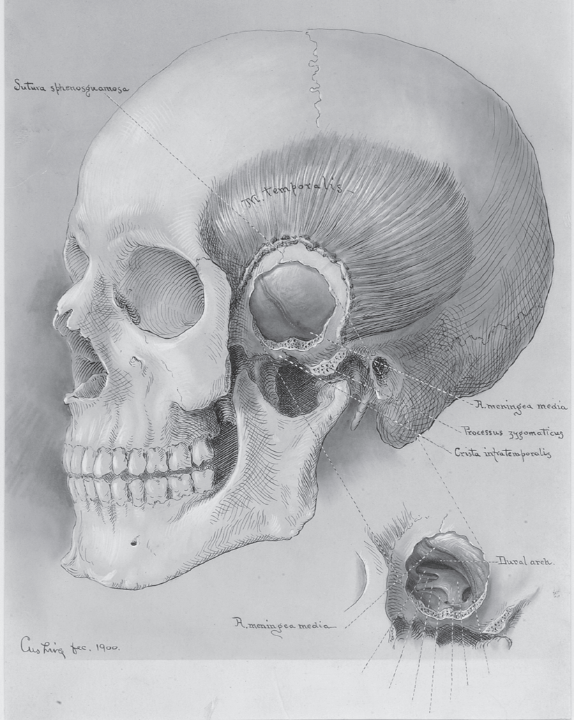 库欣的素描作品，来自他的一台手术（耶鲁大学哈维·库欣约翰·海伊·惠特尼医学图书馆的医学史资料室）   出版社供图